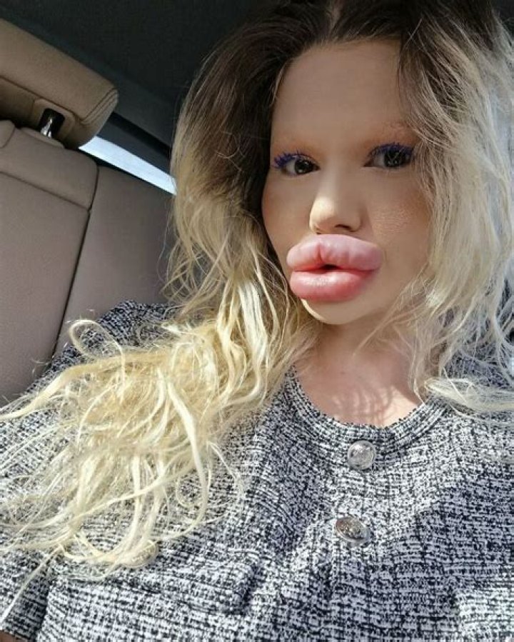  'Real-Life Barbie' with the 'biggest lips in the world' shows off huge new pout after 20th filler Injection (photos)