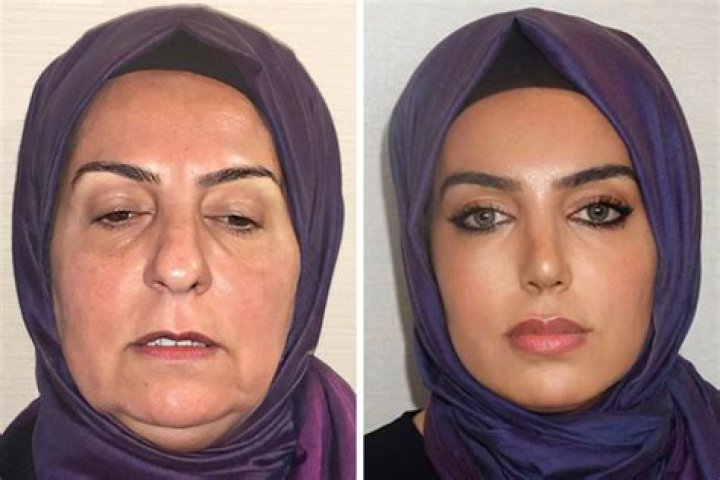'Why are so many of us Brits flying to Turkey for plastic surgery?'