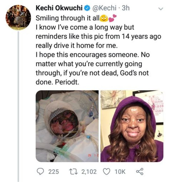 Accident survivor shares graphic before and now photos after plane crash survivor, Kechi Okwuchi shared hers