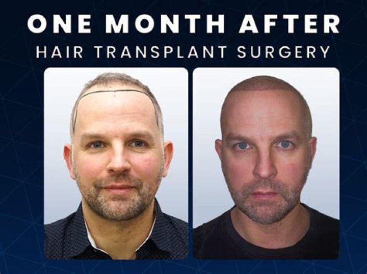Bald man shows off incredible transformation post hair transplant surgery