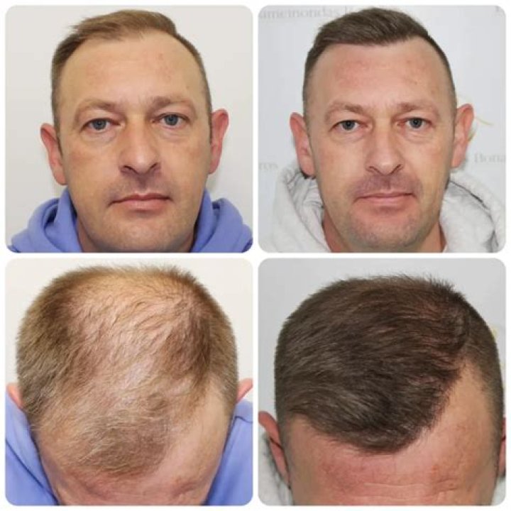 Britain's Got Talent star George Sampson reveals incredible results of third hair transplant