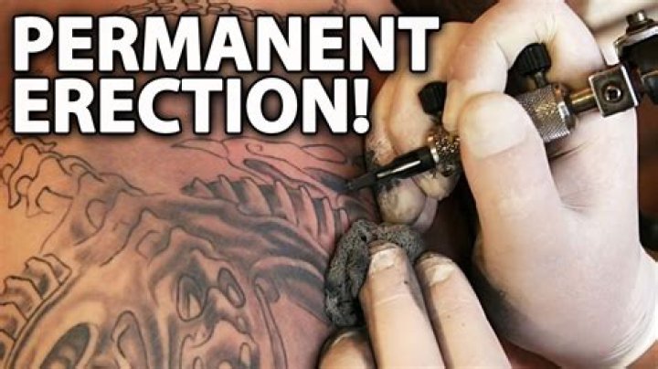 Penis Tattoo Leads to Permanent Erection