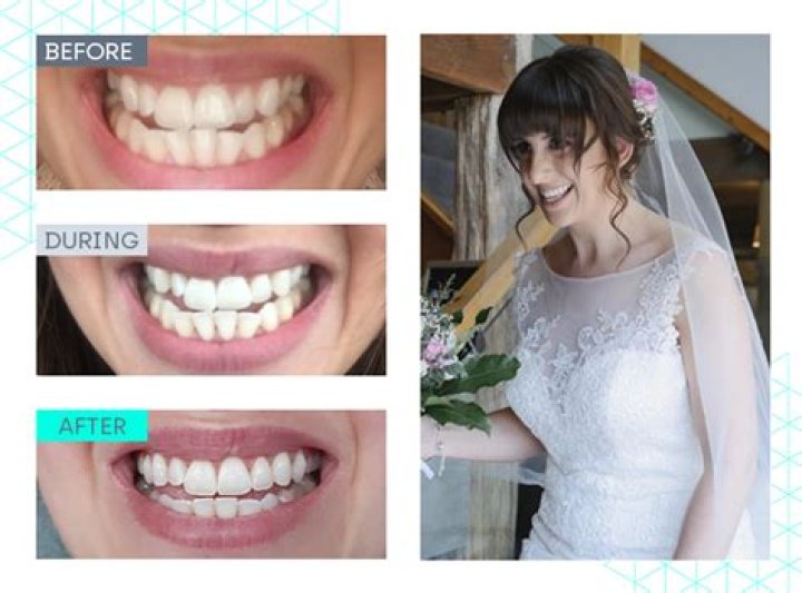 Wedding smile makeover guide: A cosmetic dentist reveals how much it costs to make your teeth look picture perfect